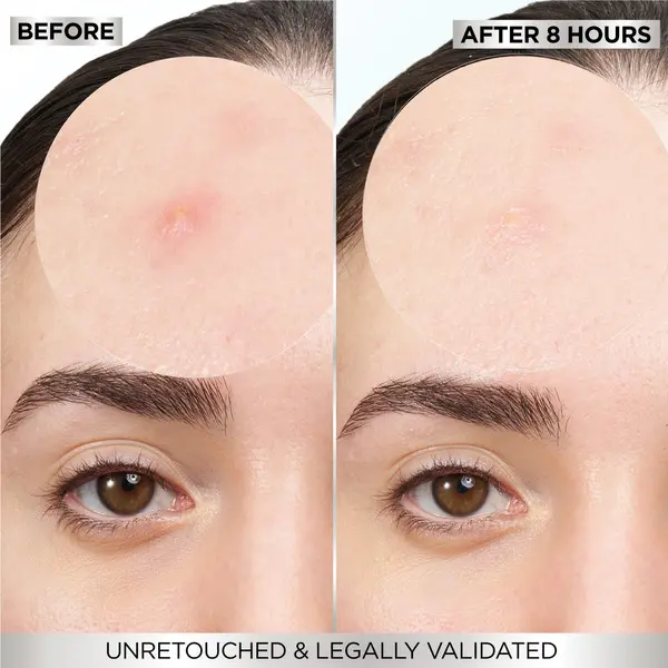 Skin Active Fast Clear Invisible Pimple Patch 8 Hours Hydrocolloid  7 Image